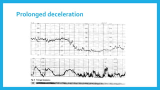 Prolonged deceleration
 