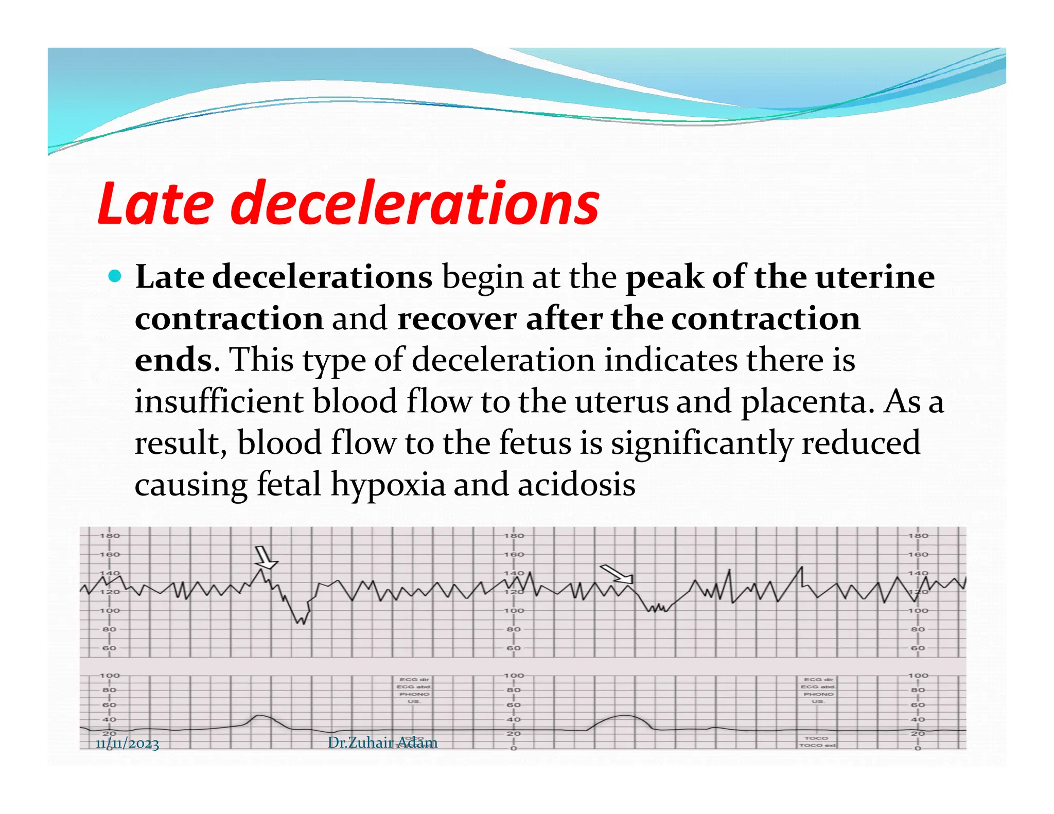 CTG INTERPRETATION Dr zuhair 2023.pdf