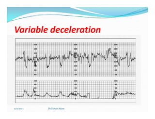 Variable deceleration
Variable deceleration
11/11/2023 Dr.Zuhair Adam
 