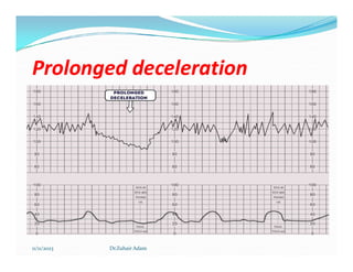 Prolonged deceleration
Prolonged deceleration
11/11/2023 Dr.Zuhair Adam
 