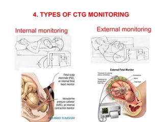 4. TYPES OF CTG MONITORING
External monitoringInternal monitoring
ABOUBAKR ELNASHAR
 