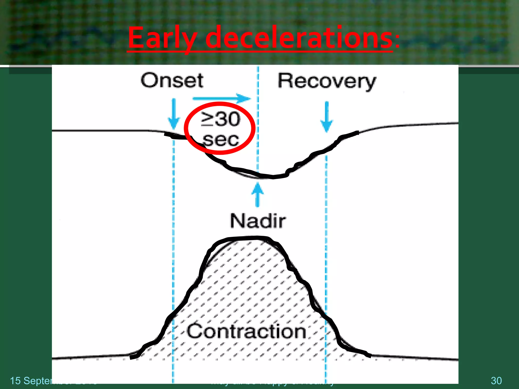 Early decelerations:
15 September 2018 May all be Happy & Healthy 30
 