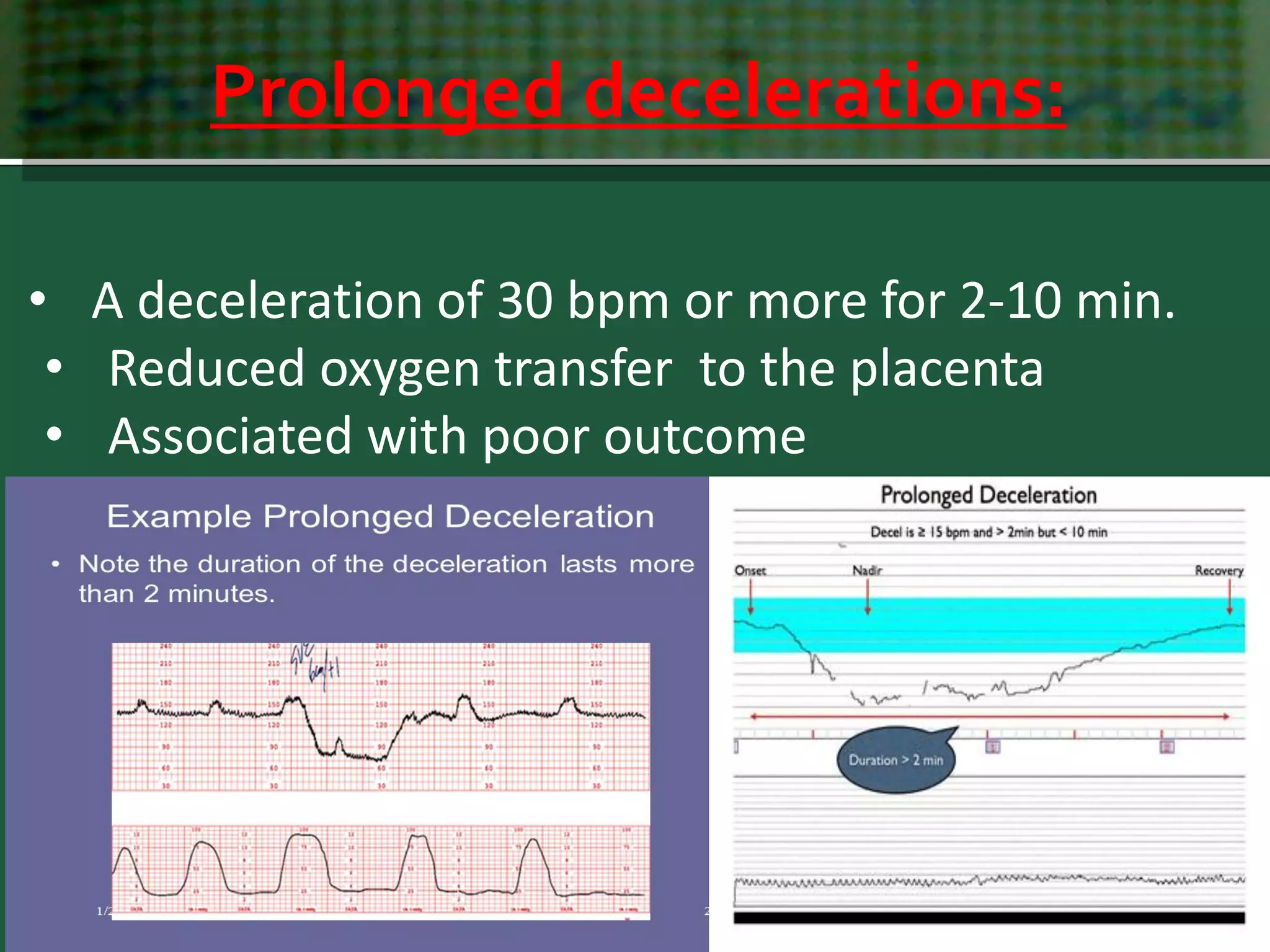 Prolonged decelerations:
15 September 2018 May All Be Happy & Healthy 42
• A deceleration of 30 bpm or more for 2-10 min.
• Reduced oxygen transfer to the placenta
• Associated with poor outcome
 