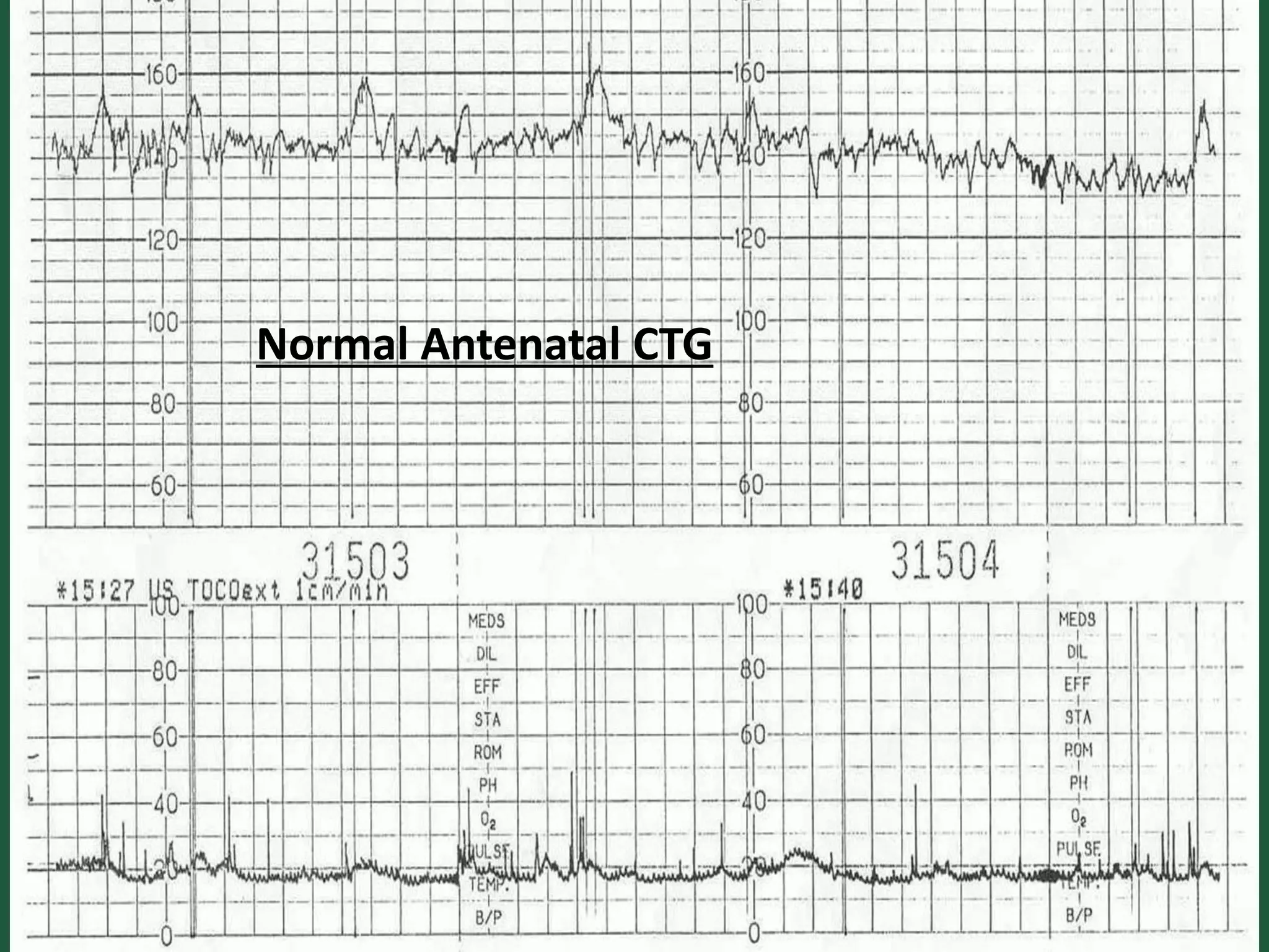 Normal Antenatal CTG
 