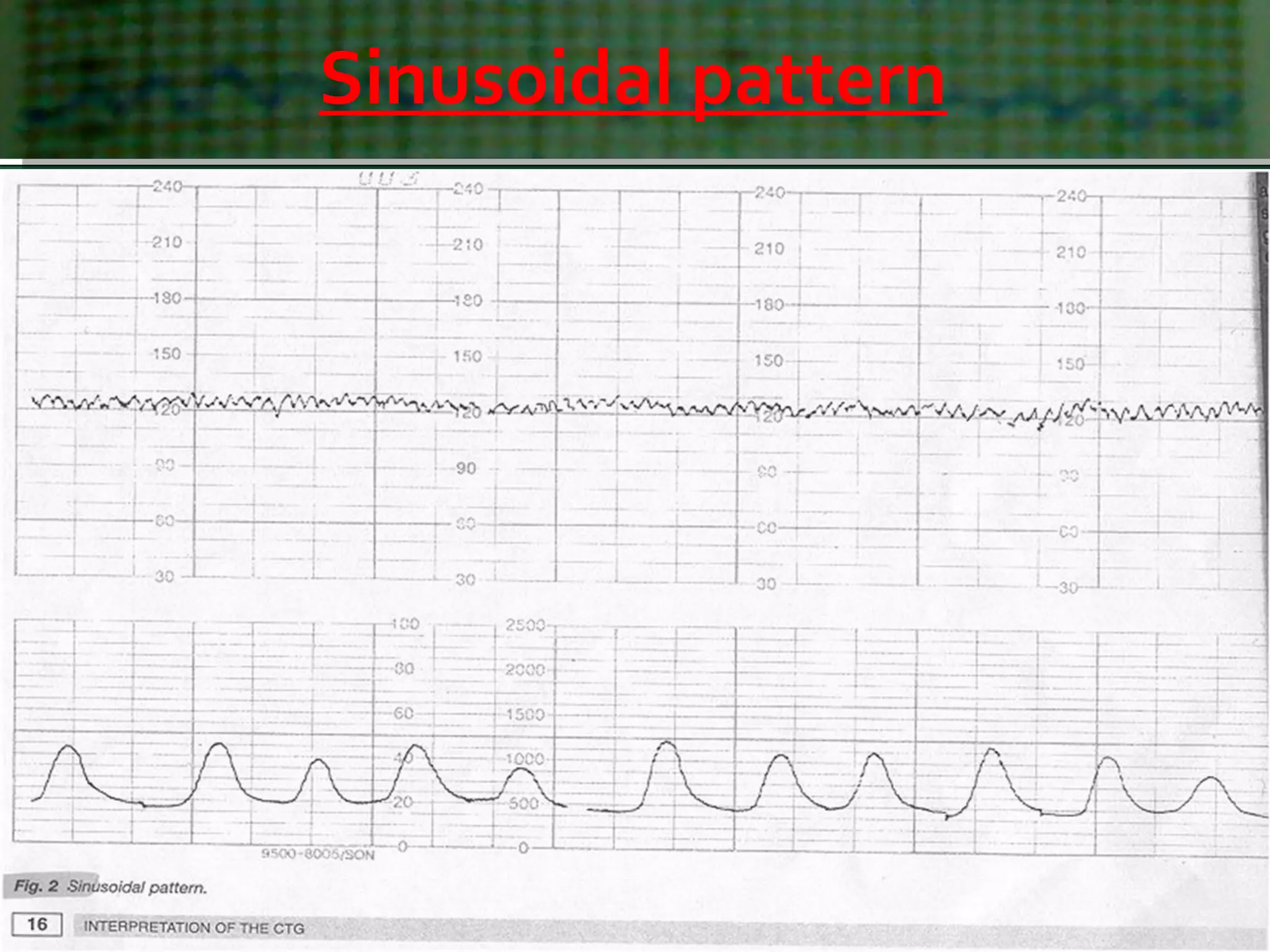 Sinusoidal pattern
 