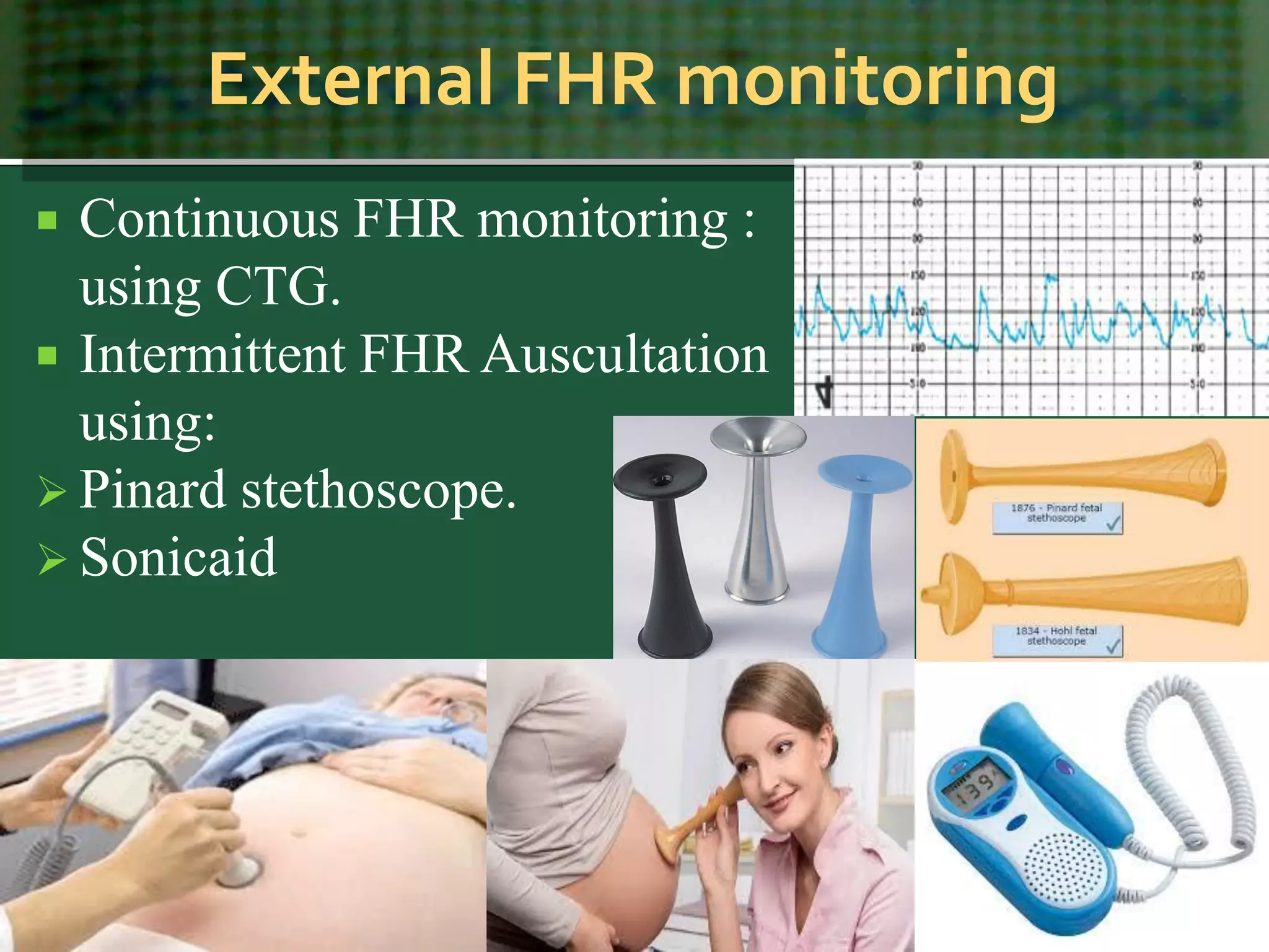 External FHR monitoring
 Continuous FHR monitoring :
using CTG.
 Intermittent FHR Auscultation
using:
 Pinard stethoscope.
 Sonicaid
 