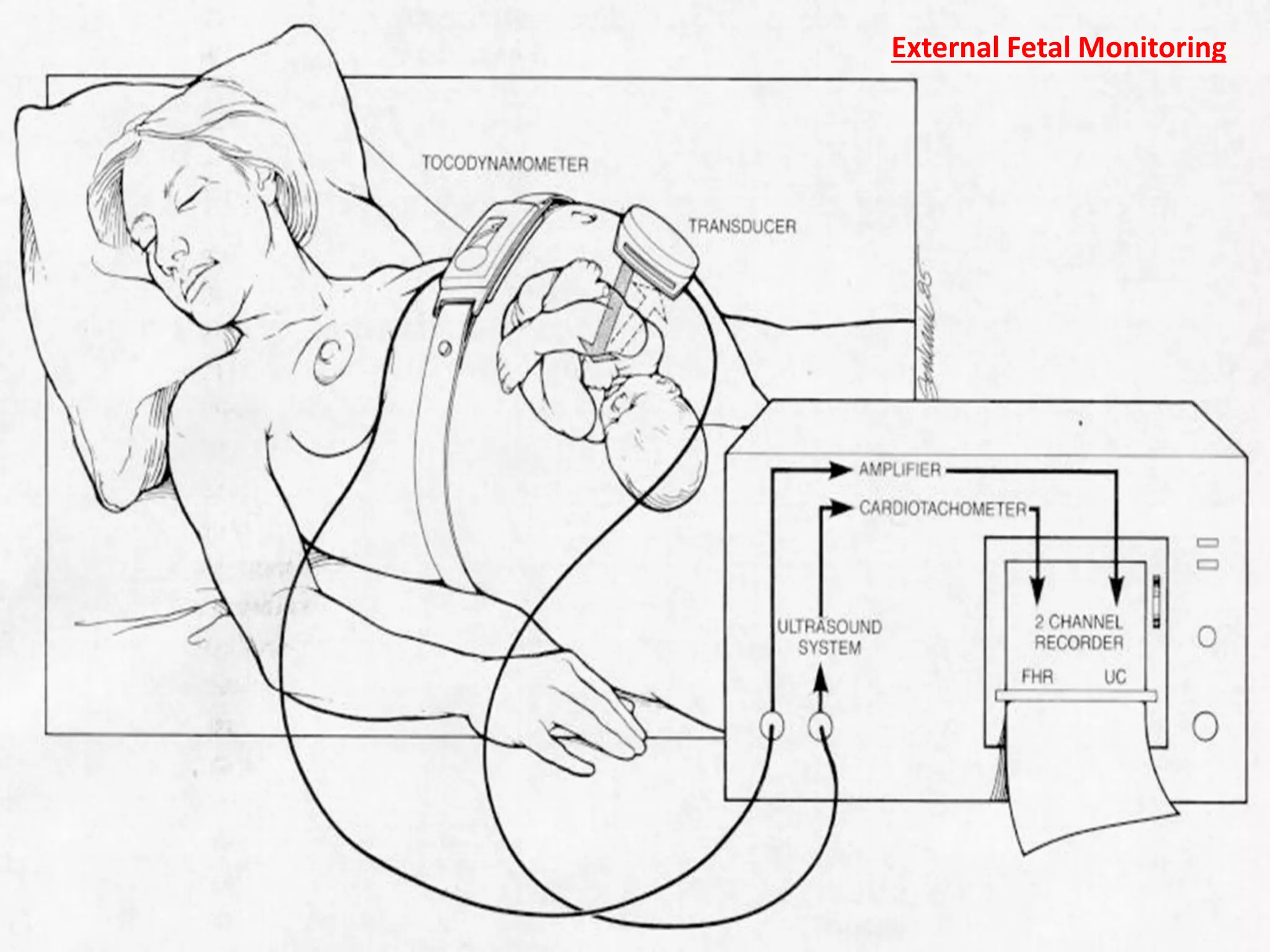 (CTG)???
External Fetal Monitoring
 