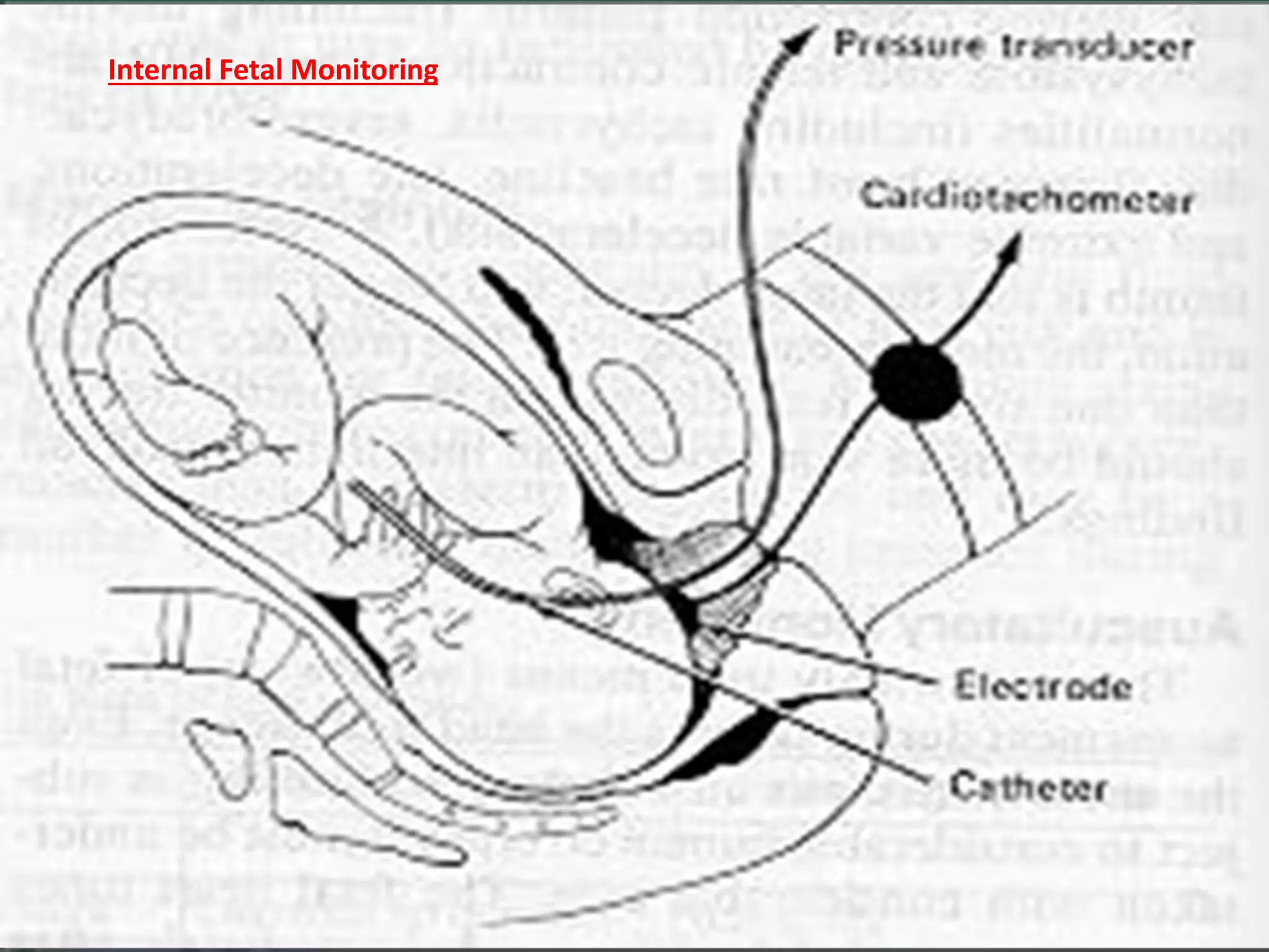 Internal Fetal Monitoring
 