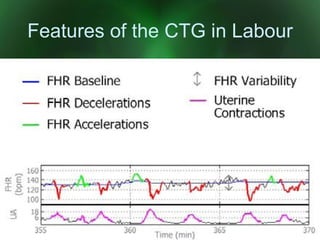 CTG Monitoring | PPT