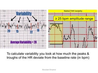 To calculate variability you look at how much the peaks &
troughs of the HR deviate from the baseline rate (in bpm)
≥ 25 bpm amplitude range
Aboubakr Elnashar
 