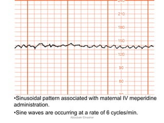 •Sinusoidal pattern associated with maternal IV meperidine
administration.
•Sine waves are occurring at a rate of 6 cycles/min.
Aboubakr Elnashar
 