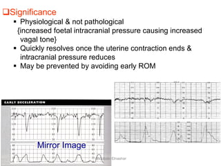Significance
 Physiological & not pathological
{increased foetal intracranial pressure causing increased
vagal tone}
 Quickly resolves once the uterine contraction ends &
intracranial pressure reduces
 May be prevented by avoiding early ROM
Mirror Image
Aboubakr Elnashar
 