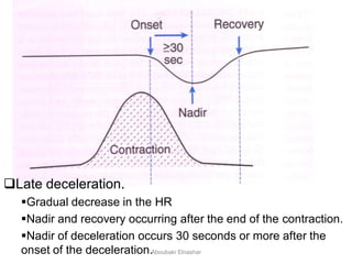 Late deceleration.
Gradual decrease in the HR
Nadir and recovery occurring after the end of the contraction.
Nadir of deceleration occurs 30 seconds or more after the
onset of the deceleration.Aboubakr Elnashar
 