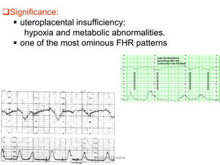 Significance:
 uteroplacental insufficiency:
hypoxia and metabolic abnormalities.
 one of the most ominous FHR patterns
Aboubakr Elnashar
 