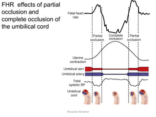 FHR effects of partial
occlusion and
complete occlusion of
the umbilical cord
Aboubakr Elnashar
 