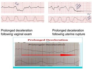 Prolonged deceleration
following uterine rupture
Prolonged deceleration
following vaginal exam
Aboubakr Elnashar
 