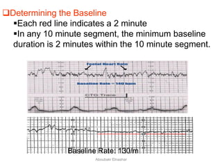 Determining the Baseline
Each red line indicates a 2 minute
In any 10 minute segment, the minimum baseline
duration is 2 minutes within the 10 minute segment.
Baseline Rate: 130/m
Aboubakr Elnashar
 