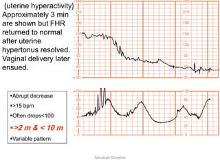 Abrupt decrease
>15 bpm
Often drops<100
>2 m & < 10 m
Variable pattern
{uterine hyperactivity}
Approximately 3 min
are shown but FHR
returned to normal
after uterine
hypertonus resolved.
Vaginal delivery later
ensued.
Aboubakr Elnashar
 