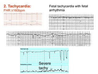 2. Tachycardia:
FHR ≥160bpm
Fetal tachycardia with fetal
arrhythmia
Severe
tachy
Aboubakr Elnashar
 