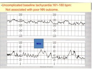 Uncomplicated baseline tachycardia:161-180 bpm:
Not associated with poor NN outcome.
Mild
Aboubakr Elnashar
 