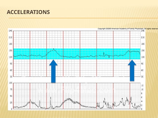 Fetal Monitoring In Labour Presentation Pptx
