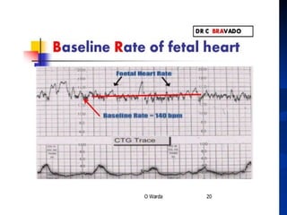 Ctg Chart Examples ctg presentation and interpretation and management | PPT