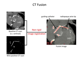 CT guided CTO PCI | PPTX