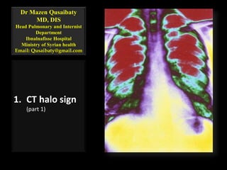 Dr Mazen Qusaibaty
MD, DIS
Head Pulmonary and Internist
Department
Ibnalnafisse Hospital
Ministry of Syrian health
Email: Qusaibaty@gmail.com
1. CT halo sign
(part 1)
 