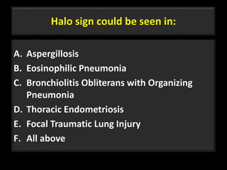 Halo sign could be seen in:
A. Aspergillosis
B. Eosinophilic Pneumonia
C. Bronchiolitis Obliterans with Organizing
Pneumonia
D. Thoracic Endometriosis
E. Focal Traumatic Lung Injury
F. All above
10
 