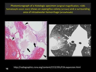 Photomicrograph of a histologic specimen (original magnification, ×100;
hematoxylin-eosin stain) shows an aspergillus colony (arrows) and a surrounding
area of intraalveolar hemorrhage (arrowheads)
16
http://radiographics.rsna.org/content/27/2/391/F24.expansion.html
 