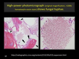 High-power photomicrograph (original magnification, ×1000;
hematoxylin-eosin stain) shows fungal hyphae.
17
http://radiographics.rsna.org/content/27/2/391/F25.expansion.html
 