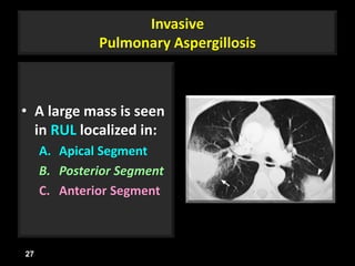 Invasive
Pulmonary Aspergillosis
• A large mass is seen
in RUL localized in:
A. Apical Segment
B. Posterior Segment
C. Anterior Segment
27
 