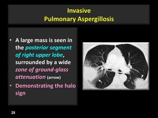 Invasive
Pulmonary Aspergillosis
• A large mass is seen in
the posterior segment
of right upper lobe,
surrounded by a wide
zone of ground-glass
attenuation (arrow)
• Demonstrating the halo
sign
28
 