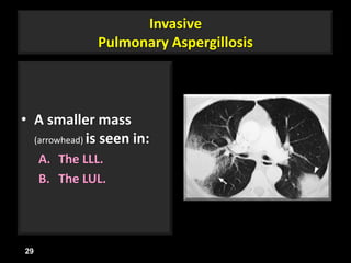 Invasive
Pulmonary Aspergillosis
• A smaller mass
(arrowhead) is seen in:
A. The LLL.
B. The LUL.
29
 