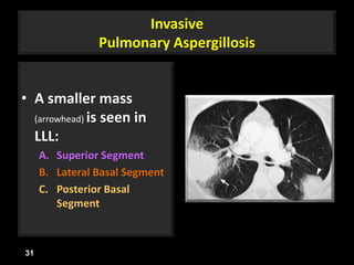 Invasive
Pulmonary Aspergillosis
• A smaller mass
(arrowhead) is seen in
LLL:
A. Superior Segment
B. Lateral Basal Segment
C. Posterior Basal
Segment
31
 