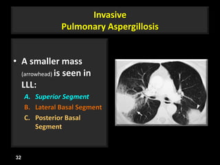Invasive
Pulmonary Aspergillosis
• A smaller mass
(arrowhead) is seen in
LLL:
A. Superior Segment
B. Lateral Basal Segment
C. Posterior Basal
Segment
32
 