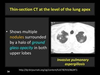 Thin-section CT at the level of the lung apex
• Shows multiple
nodules surrounded
by a halo of ground
glass opacity in both
upper lobes
34
http://bjr.birjournals.org/cgi/content/full/78/933/862#T1
Invasive pulmonary
aspergillosis
 