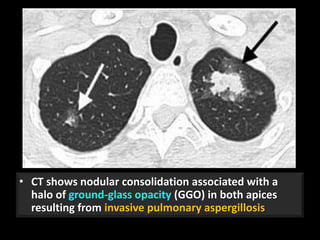 • CT shows nodular consolidation associated with a
halo of ground-glass opacity (GGO) in both apices
resulting from invasive pulmonary aspergillosis
35
 