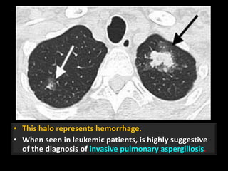 • This halo represents hemorrhage.
• When seen in leukemic patients, is highly suggestive
of the diagnosis of invasive pulmonary aspergillosis.
36
 