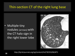 Thin-section CT of the right lung base
• Multiple tiny
nodules (arrows) with
the CT halo sign in
the right lower lobe
38
http://bjr.birjournals.org/cgi/content/full/78/933/862#T1
 