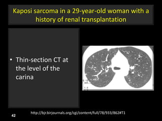 Kaposi sarcoma in a 29-year-old woman with a
history of renal transplantation
• Thin-section CT at
the level of the
carina
42
http://bjr.birjournals.org/cgi/content/full/78/933/862#T1
 