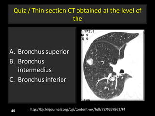 Quiz / Thin-section CT obtained at the level of
the
A. Bronchus superior
B. Bronchus
intermedius
C. Bronchus inferior
45 http://bjr.birjournals.org/cgi/content-nw/full/78/933/862/F4
 