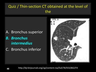 Quiz / Thin-section CT obtained at the level of
the
A. Bronchus superior
B. Bronchus
intermedius
C. Bronchus inferior
46 http://bjr.birjournals.org/cgi/content-nw/full/78/933/862/F4
 