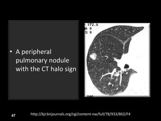 • A peripheral
pulmonary nodule
with the CT halo sign
47 http://bjr.birjournals.org/cgi/content-nw/full/78/933/862/F4
 