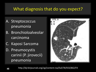 What diagnosis that do you expect?
A. Streptococcus
pneumonia
B. Bronchioloalveolar
carcinoma
C. Kaposi Sarcoma
D. Pneumocystis
carinii (P. jirovecii)
pneumonia
48 http://bjr.birjournals.org/cgi/content-nw/full/78/933/862/F4
 