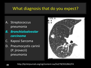 What diagnosis that do you expect?
A. Streptococcus
pneumonia
B. Bronchioloalveolar
carcinoma
C. Kaposi Sarcoma
D. Pneumocystis carinii
(P. jirovecii)
pneumonia
49 http://bjr.birjournals.org/cgi/content-nw/full/78/933/862/F4
 