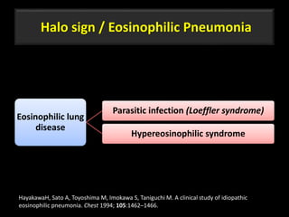 Halo sign / Eosinophilic Pneumonia
Eosinophilic lung
disease
Parasitic infection (Loeffler syndrome)
Hypereosinophilic syndrome
52
HayakawaH, Sato A, Toyoshima M, Imokawa S, Taniguchi M. A clinical study of idiopathic
eosinophilic pneumonia. Chest 1994; 105:1462–1466.
 