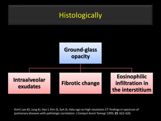 Histologically
Ground-glass
opacity
Intraalveolar
exudates
Fibrotic change
Eosinophilic
infiltration in
the interstitium
53
KimY, Lee KS, Jung KJ, Han J, Kim JS, Suh JS. Halo sign on high resolution CT: findings in spectrum of
pulmonary diseases with pathologic correlation. J Comput Assist Tomogr 1999; 23: 622–626.
 