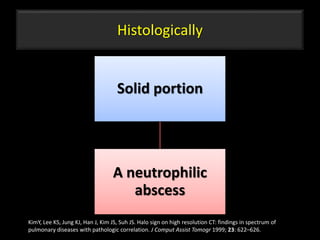 Histologically
Solid portion
A neutrophilic
abscess
54
KimY, Lee KS, Jung KJ, Han J, Kim JS, Suh JS. Halo sign on high resolution CT: findings in spectrum of
pulmonary diseases with pathologic correlation. J Comput Assist Tomogr 1999; 23: 622–626.
 