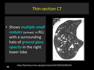 Thin-section CT
• Shows multiple small
nodules (arrows) in RLL
with a surrounding
halo of ground glass
opacity in the right
lower lobe
55
http://bjr.birjournals.org/cgi/content/full/78/933/862/F6
 